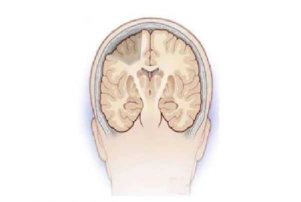 Lesionectomy