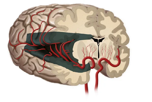 Hemispherectomy