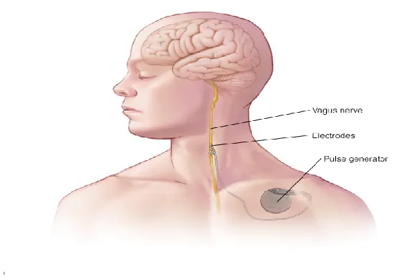 Vagus Nerve Stimulation