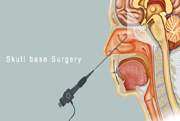 Skull Base Surgery