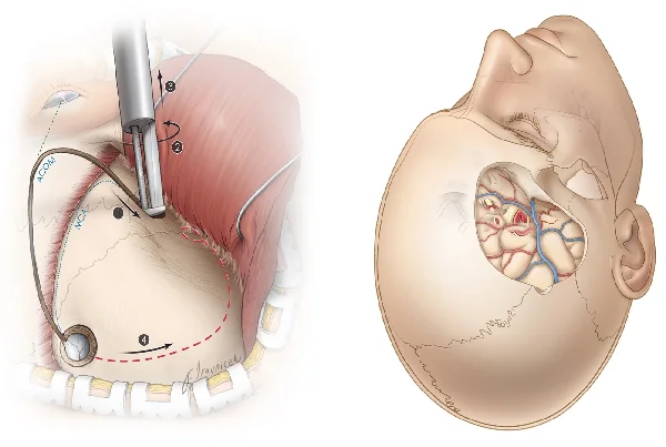 Craniotomy Surgery