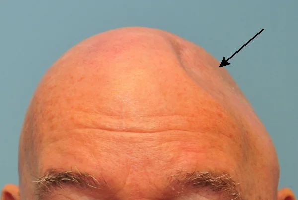 Cranioplasty