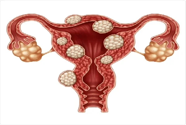 Uterine Fibroid Treatment