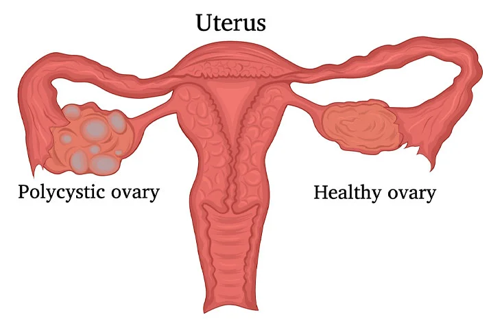 PCOS Treatment