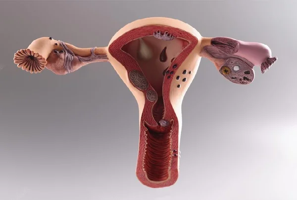 Uterine Bleeding