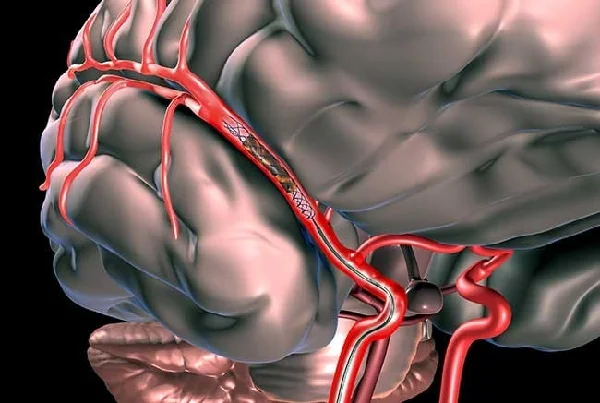 Blood Clot Brain Surgery