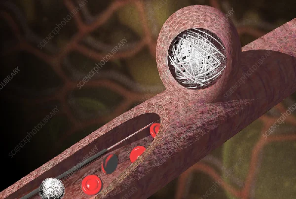 Endovascular Coiling