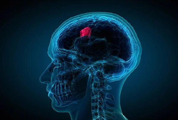 Pineal Region Tumors Treatment