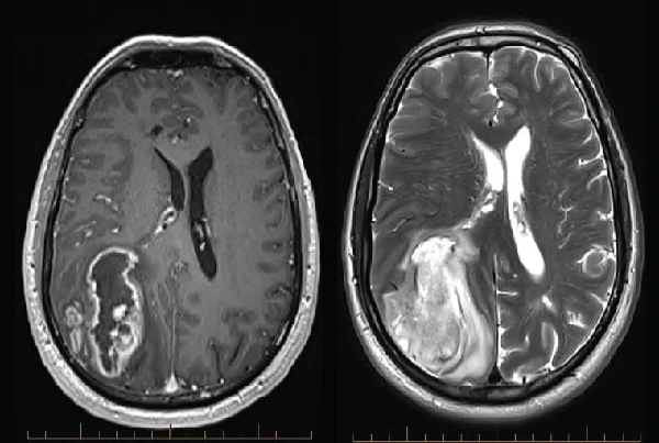Gliomas Treatment