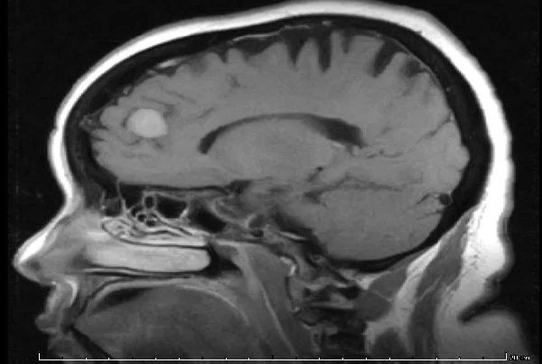 Meningioma