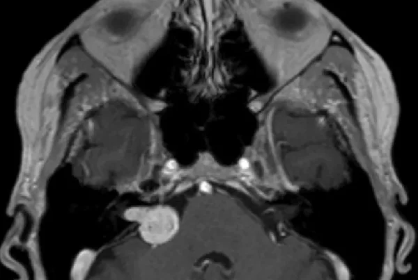 Schwannomas