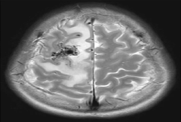 Gamma Knife for AVM
