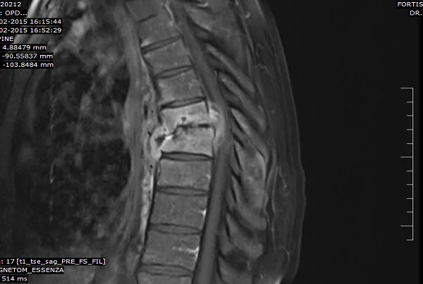 Spine Tuberculosis