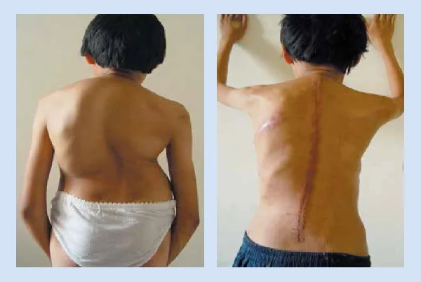 Complex Spine Surgery