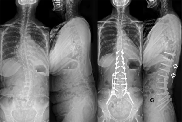 Spinal Deformity Surgery
